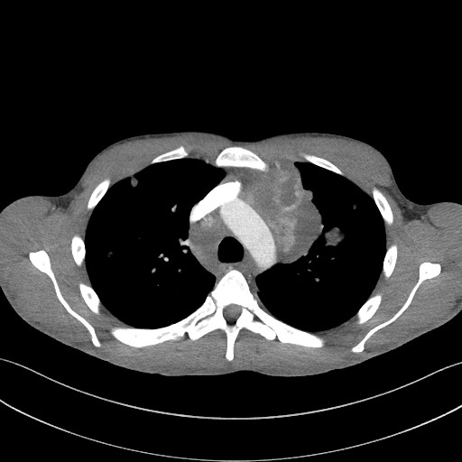 Cannonball metastases - testicular choriocarcinoma (Radiopaedia 84510-99891 B 42).jpg
