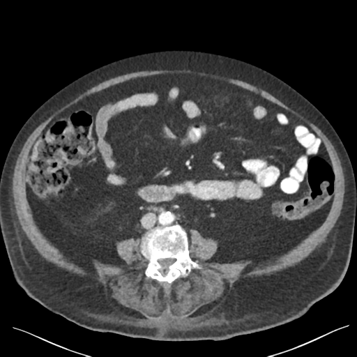 Cannonball metastases from endometrial cancer (Radiopaedia 42003-45031 E 45).png