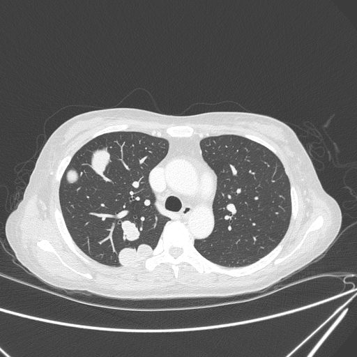 Canonball lung metastasis (Radiopaedia 77634-89837 Axial lung window 61).jpg