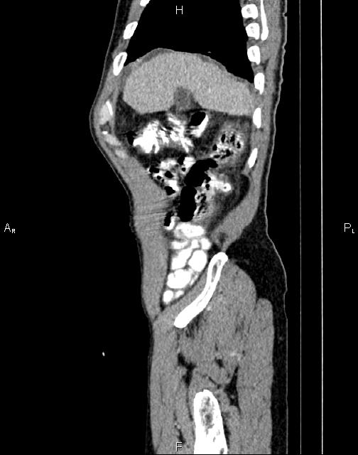 Caput medusae sign - portal hypertension (Radiopaedia 64007-72759 B 3).jpg