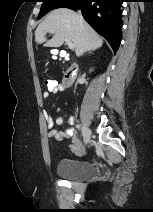 Carcinoid tumor - terminal ileum (Radiopaedia 60931-68739 C 61).jpg