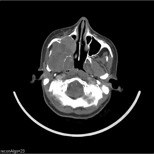 Carcinoma of the maxillary antrum (Radiopaedia 53805-59888 Axial C+ delayed 54).jpg