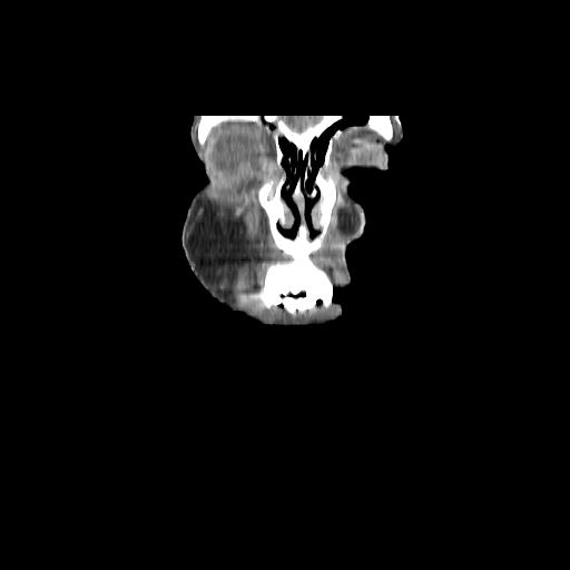 Carcinoma of the maxillary antrum (Radiopaedia 53805-59888 Coronal C+ delayed 12).jpg