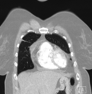 Cardiac sarcoidosis (Radiopaedia 74548-85534 Coronal lung window 10).jpg