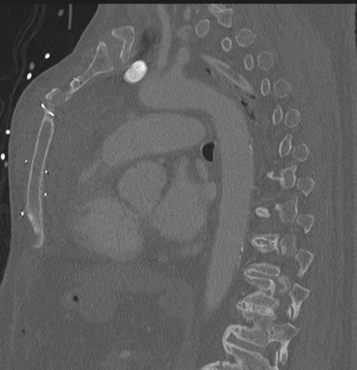 Cardiac trauma (Radiopaedia 32874-33858 Sagittal bone window 25).jpg