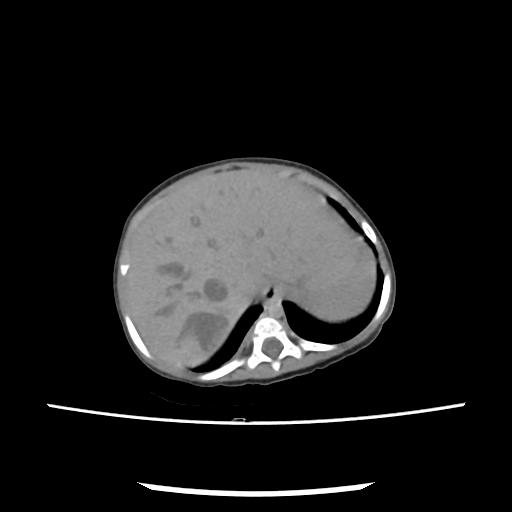 Caroli disease with autosomal recessive polycystic kidney disease (ARPKD) (Radiopaedia 89651-106703 E 33).jpg