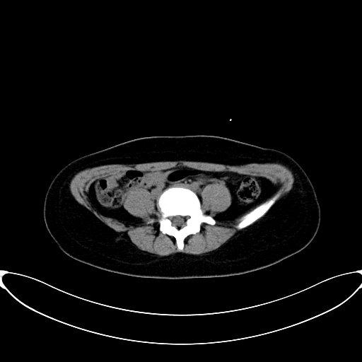 Caroli disease with medullary sponge kidney (Radiopaedia 82622-96804 Axial non-contrast 49).jpg