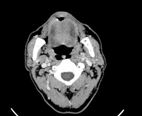 Carotid body tumor (Radiopaedia 61750-69757 Axial Post contrast 27).jpg
