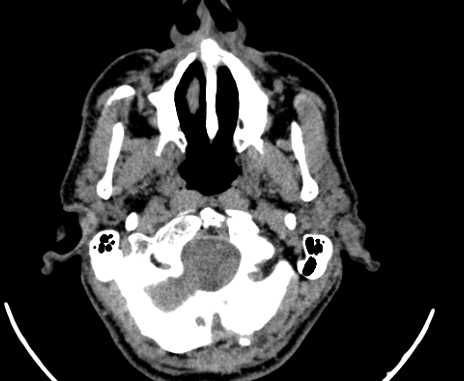 Carotid body tumor (Radiopaedia 61750-69757 Axial non-contrast 4).jpg