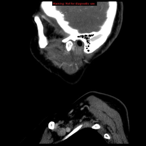 Carotid body tumor with lung metastases (Radiopaedia 9301-9986 Sagittal C+ delayed 4).jpg