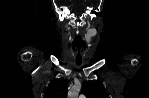 File:Carotid bulb pseudoaneurysm (Radiopaedia 57670-64616 D 21).jpg