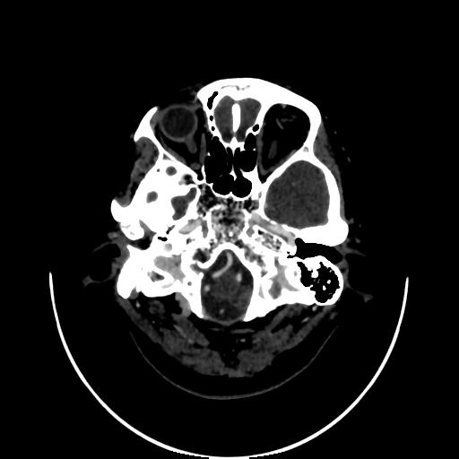 Cavernoma with developmental venous anomaly (Radiopaedia 22470-22506 C 11).jpg