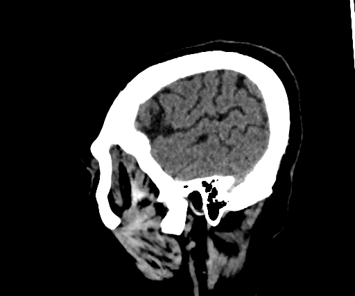 Cavernous hemangioma of the cerebellar falx (Radiopaedia 73025-83723 B 278).jpg