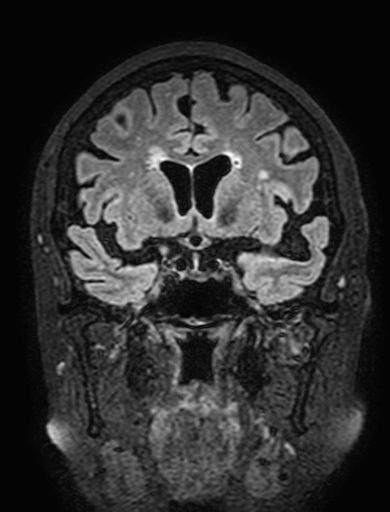 Cavernous hemangioma of the cerebellar falx (Radiopaedia 73025-83724 Coronal FLAIR 134).jpg
