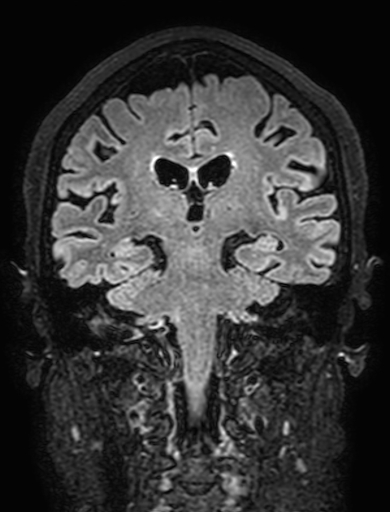 Cavernous hemangioma of the cerebellar falx (Radiopaedia 73025-83724 Coronal FLAIR 203).jpg
