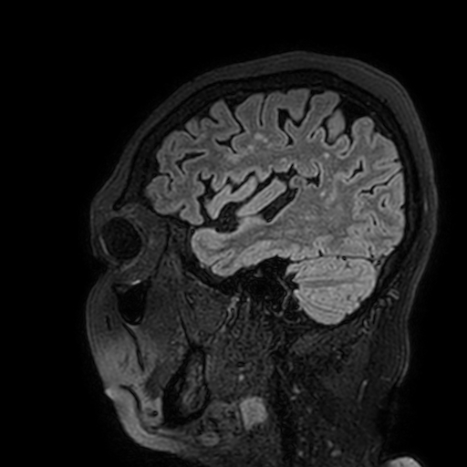 Cavernous hemangioma of the cerebellar falx (Radiopaedia 73025-83724 Sagittal FLAIR 174).jpg
