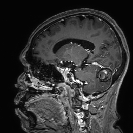 Cavernous hemangioma of the cerebellar falx (Radiopaedia 73025-83724 Sagittal T1 C+ 86).jpg