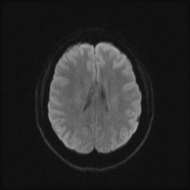 Cavernous sinus meningioma (Radiopaedia 63682-72367 DWI 35).jpg
