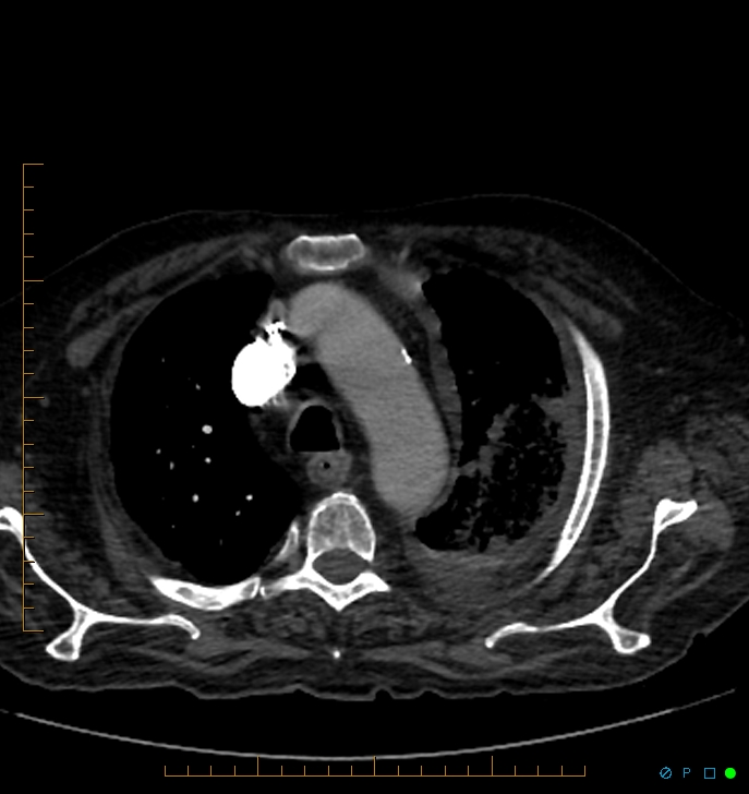 Cavitating pulmonary infarction (Radiopaedia 54634-60849 Axial C+ CTPA 12).jpg