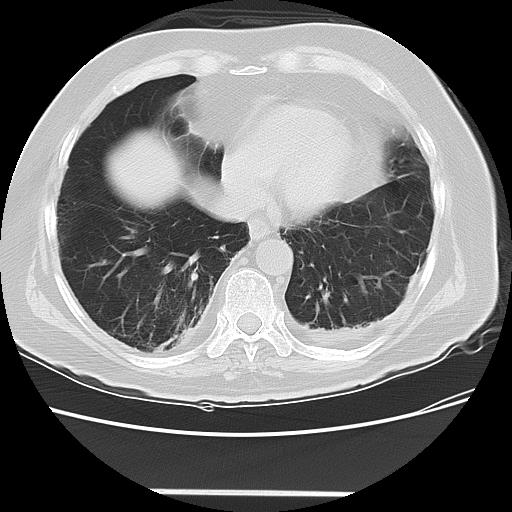 Cavitating pulmonary metastases (Radiopaedia 89545-106544 Axial lung window 41).jpg
