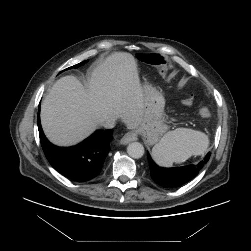 Cecal adenocarcinoma (Radiopaedia 64871-73817 A 9).jpg