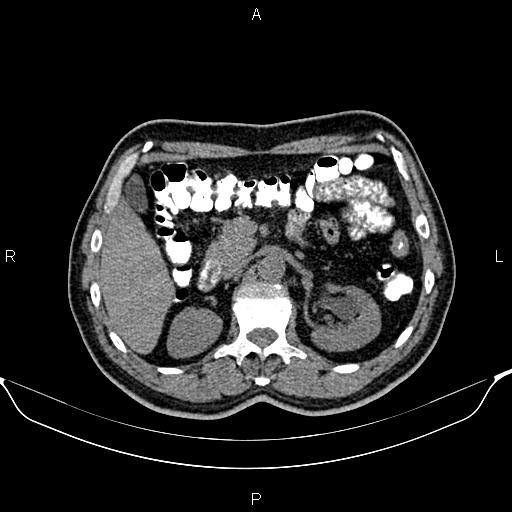Cecal adenocarcinoma (Radiopaedia 85324-100916 Axial non-contrast 33).jpg