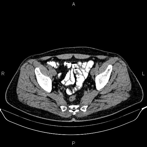 Cecal adenocarcinoma (Radiopaedia 85324-100916 Axial non-contrast 86).jpg