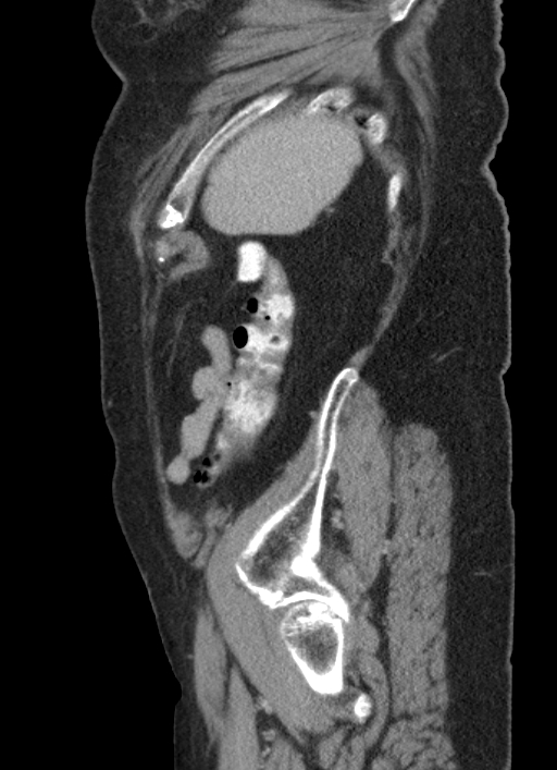 Cecal adenocarcinoma - surgical scar recurrence (Radiopaedia 79988-93264 D 12).jpg