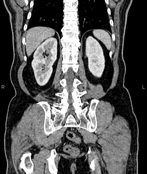 Cecal cancer with appendiceal mucocele (Radiopaedia 91080-108651 D 57).jpg