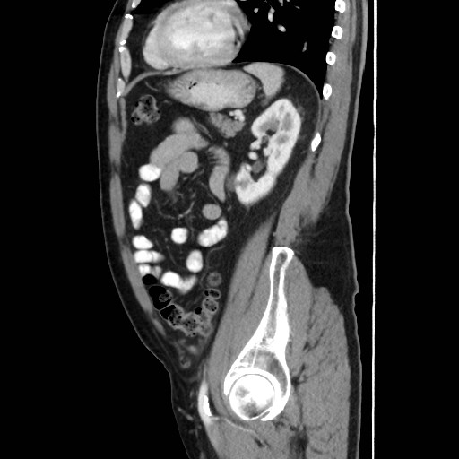 Cecal mass causing appendicitis (Radiopaedia 59207-66531 C 46).jpg