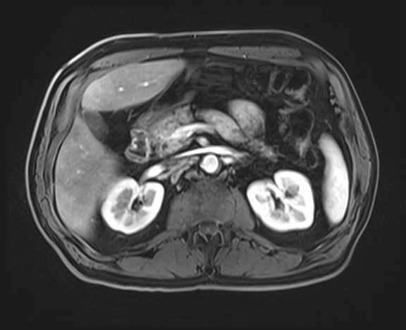 Cecal mass causing appendicitis (Radiopaedia 59207-66532 H 53).jpg