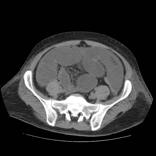 Cecal volvulus (Radiopaedia 28294-28534 Axial non-contrast 73).jpg