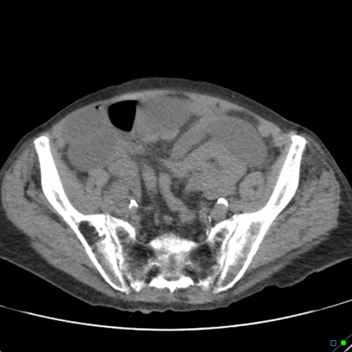Cecal volvulus - atypical (Radiopaedia 21637-21588 non-contrast 55).jpg