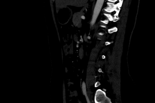 File:Celiac artery compression syndrome (Radiopaedia 47538-52152 B 60).jpg
