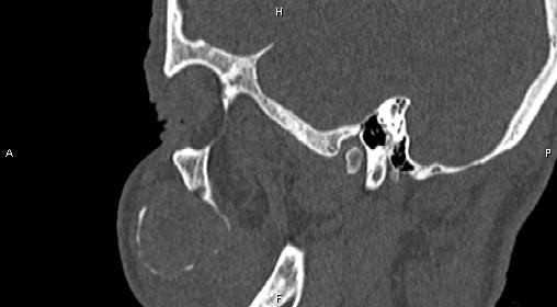 File:Central giant cell granuloma (Radiopaedia 83346-97761 Sagittal bone window 11).jpg