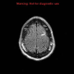 File:Central nervous system vasculitis (Radiopaedia 8410-9235 Axial FLAIR 22).jpg