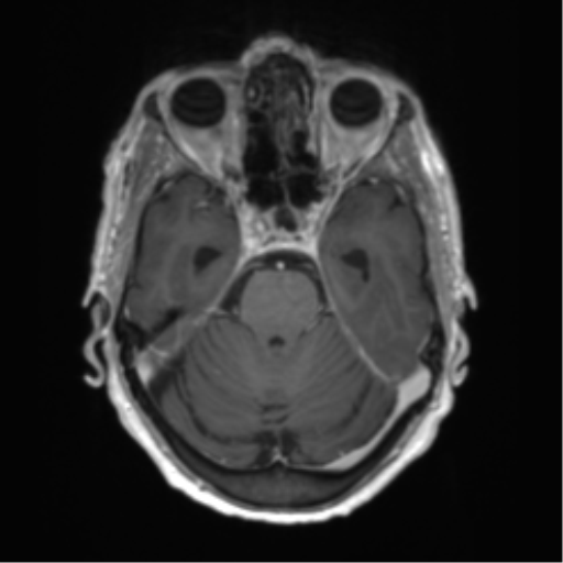 Central neurocytoma (Radiopaedia 65317-74345 Axial T1 C+ 14).png