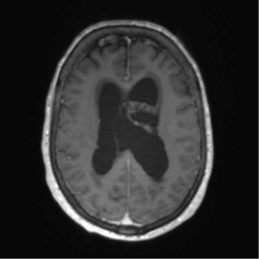 Central neurocytoma (Radiopaedia 65317-74345 Axial T1 C+ 36).png