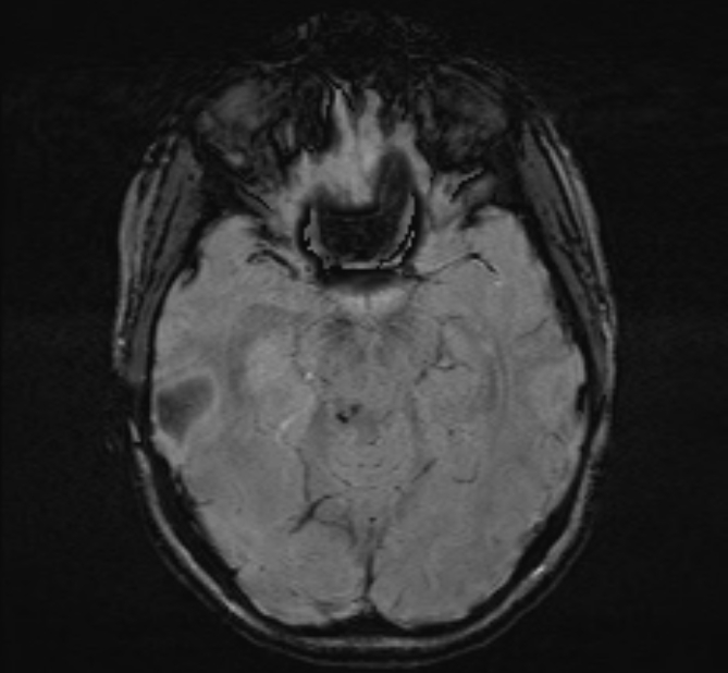 Central neurocytoma (Radiopaedia 70263-80336 Axial SWI 21).jpg