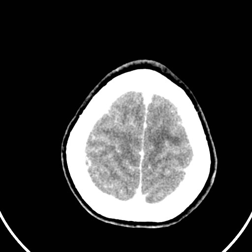 File:Central neurocytoma (Radiopaedia 84497-99871 B 44).jpg