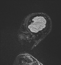 File:Central neurocytoma (Radiopaedia 84497-99872 Sagittal Flair + Gd 137).jpg