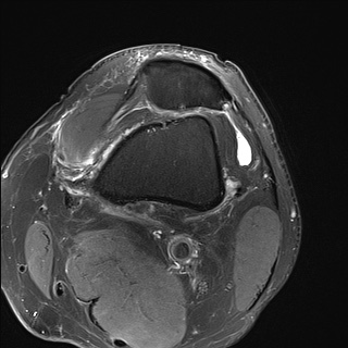 File:Central osteophyte (Radiopaedia 72592-83151 Axial PD fat sat 3).jpg