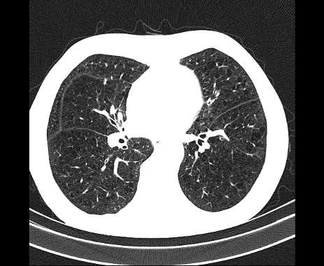 Centrilobular pulmonary emphysema (Radiopaedia 62468-70718 Axial lung window 45).jpg