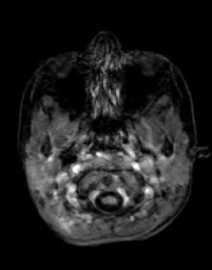 Cerebellar abscess (Radiopaedia 73727-84563 Axial T1 C+ fat sat 29).jpg
