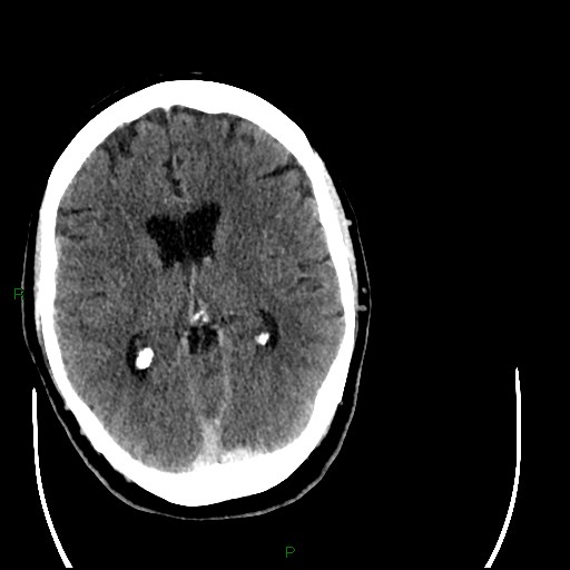 Cerebellar abscess (Radiopaedia 78135-90671 Axial C+ delayed 58).jpg