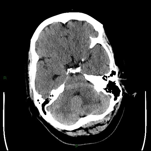Cerebellar abscess (Radiopaedia 78135-90671 Axial non-contrast 32).jpg