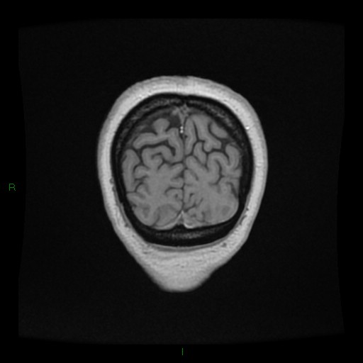 Cerebellar abscess (Radiopaedia 78135-90678 Coronal T1 C+ 157).jpg