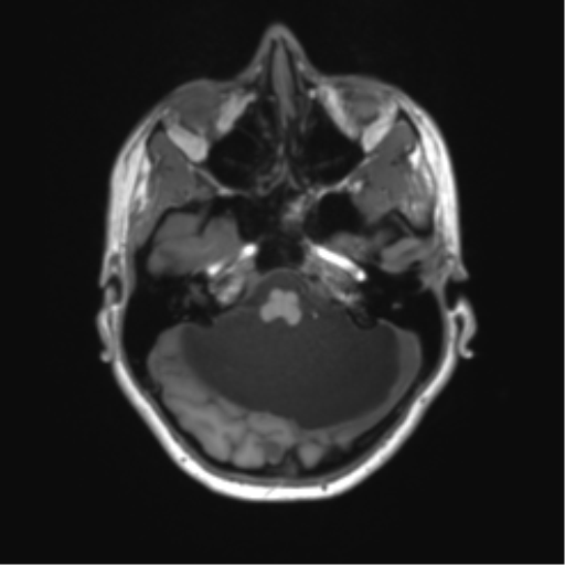Cerebellar agenesis with hypoplastic pons (pontocerebellar hypoplasia) (Radiopaedia 57224-64138 Axial T1 21).png