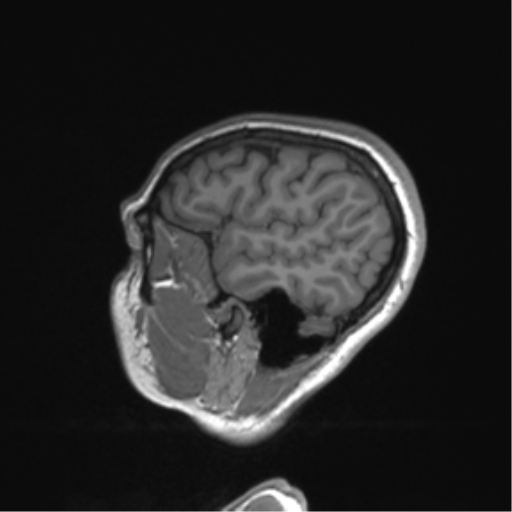 Cerebellar agenesis with hypoplastic pons (pontocerebellar hypoplasia) (Radiopaedia 57224-64138 Sagittal T1 54).png