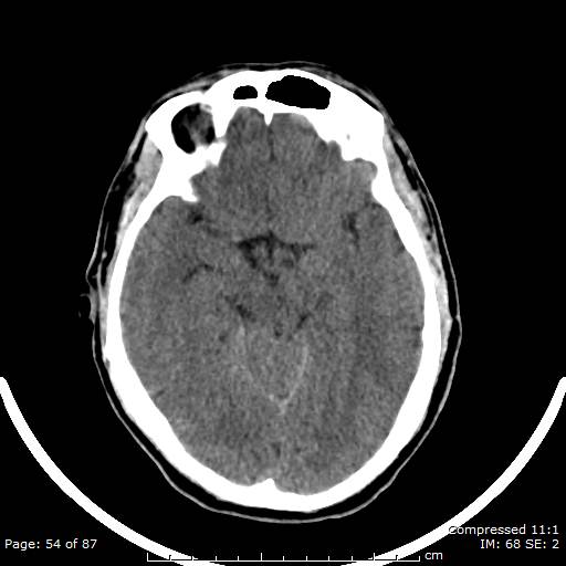 Cerebellar hemangioblastoma (Radiopaedia 52360-58258 Axial non-contrast 54).jpg